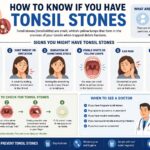 How to Know If You Have Tonsil Stones: Signs, Symptoms, and Causes how to know if you have tonsil stones